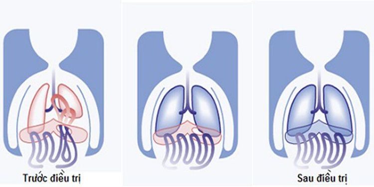 
Điều trị thoát vị hoành bẩm sinh bằng phẫu thuật
