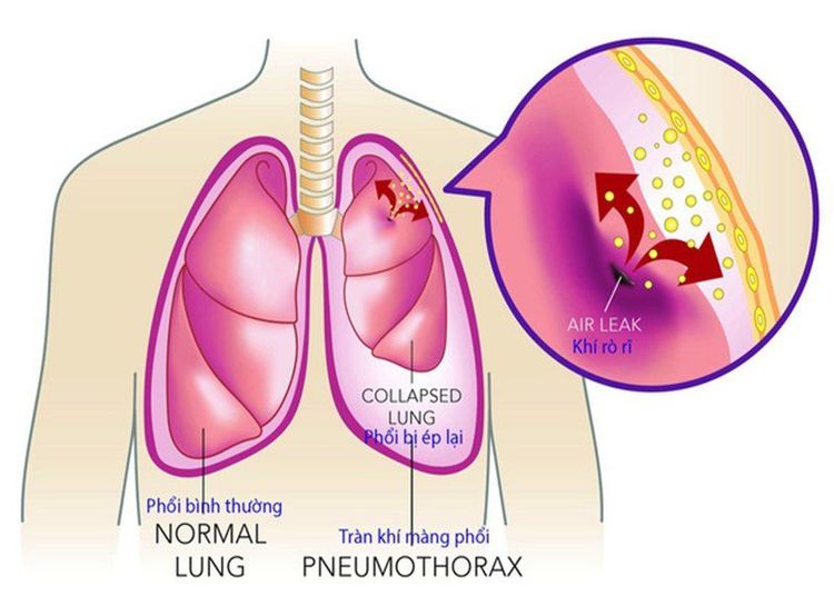 
Bệnh nhân tràn khí phổi cần được phẫu thuật nội soi
