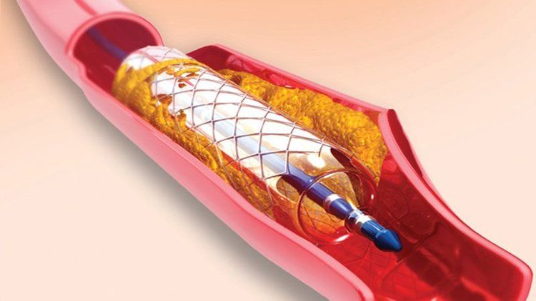 
Đặt ống thông có stent kim loại để giữ lòng mạch bình thường trở lại
