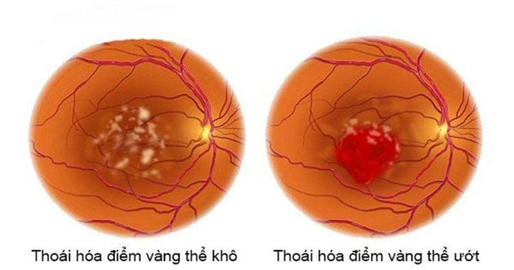 
2 loại thoái hóa điểm vàng thể khô và thoái hóa điểm vàng thể ướt
