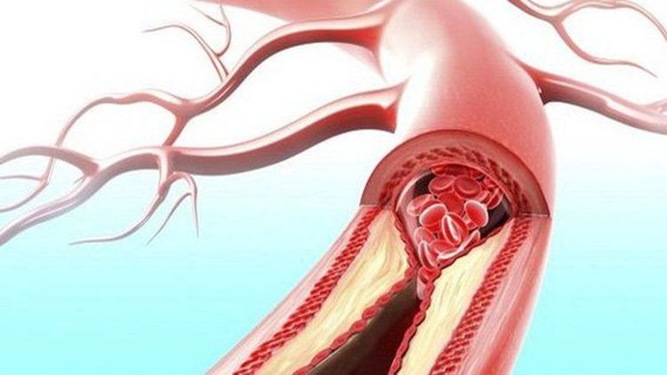 
Đông máu nội mạch lan tỏa (DIC) có thể gây thiếu máu cục bộ
