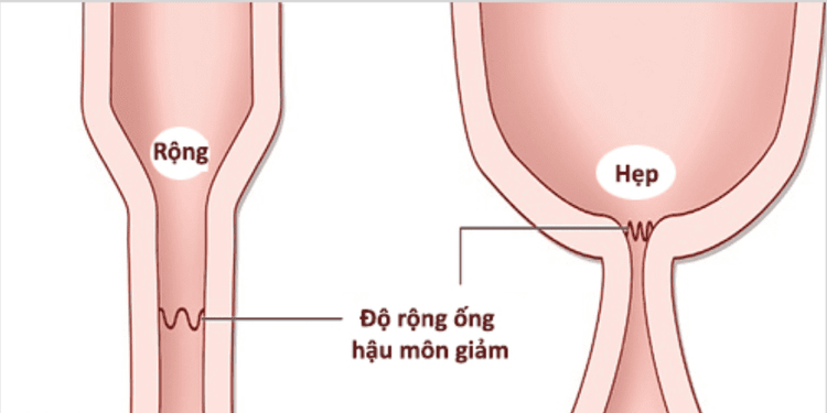 
Tình trạng hẹp hậu môn ở trẻ cần được chỉ định nong
