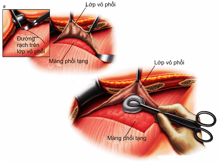 
Các bước tiến hành phẫu thuật bóc vỏ màng phổi là gì?
