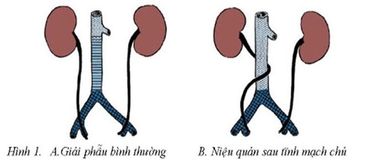 
Niệu quản sau tĩnh mạch chủ
