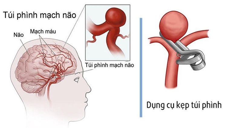 
Đặt clip ở cổ túi phình động mạch não để chặn dòng máu chảy vào túi
