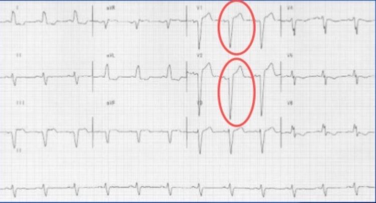 
Hình ảnh nhồi máu cơ tim thành trước cấp tính
