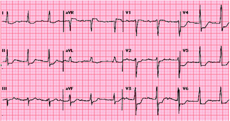 
Hình ảnh nhồi máu dưới nội tâm mạc (thất trái) trên ECG
