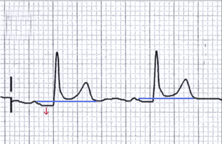 
Đoạn PR hiển thị trên kết quả điệm tâm đồ (ECG)
