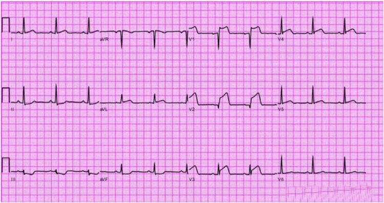 
Hình ảnh nhồi máu cơ tim ST chênh lên ECG
