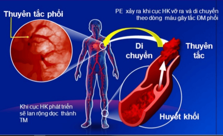 
Huyết khối dẫn đến thuyên tắc mạch
