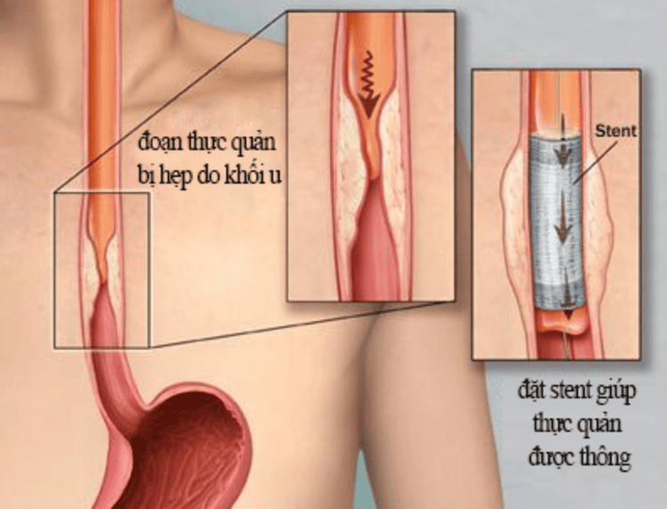 
Kỹ thuật đặt stent thực quản giúp bệnh nhân ăn uống dễ dàng hơn
