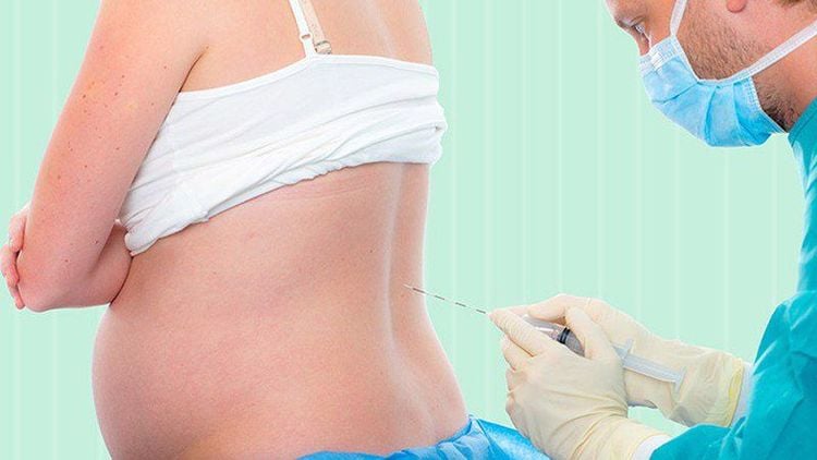 
Gây tê tủy sống là phương pháp thay thế khi không có catheter ngoài màng cứng
