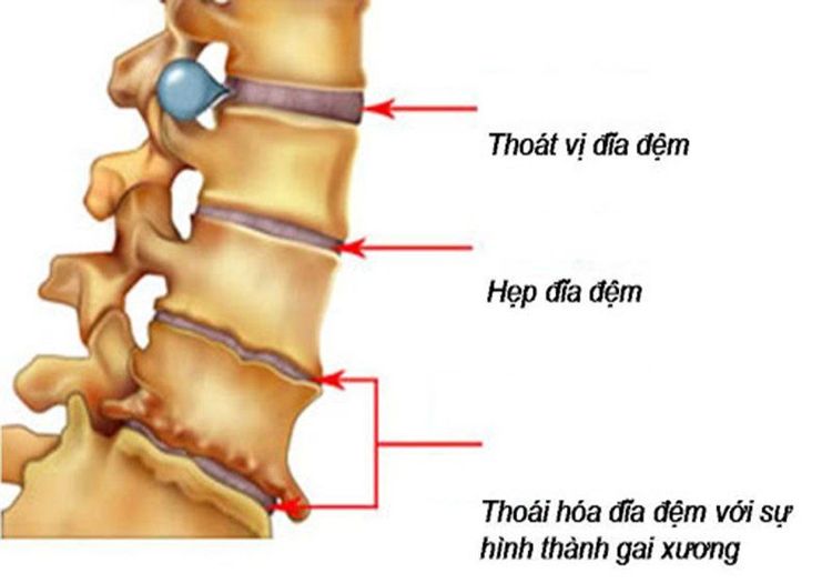 
Đau cột sống là triệu chứng phổ biến
