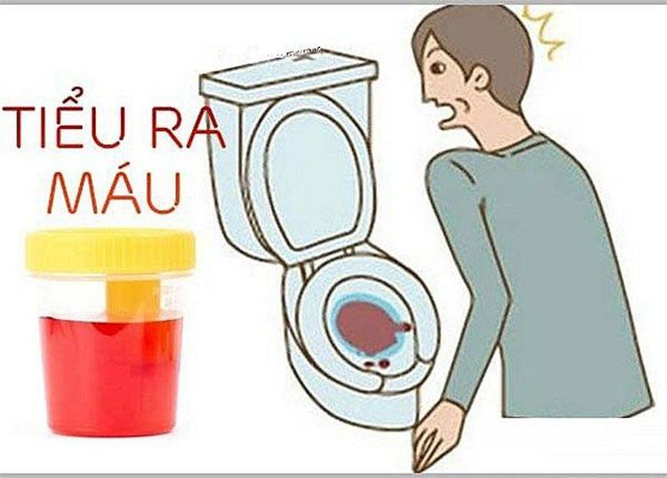 
Tiểu ra máu là triệu chứng phổ biến của bệnh
