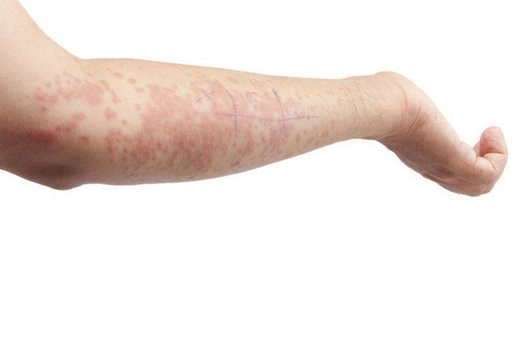 Bệnh lupus có thể ảnh hưởng đến các mạch máu