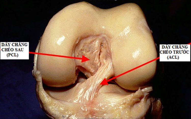 
Mất vững khớp gối có thể do tổn thương dây chằng
