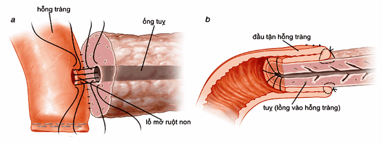 
Ống thông phải được nằm cố định trong lòng của hỗng tràng
