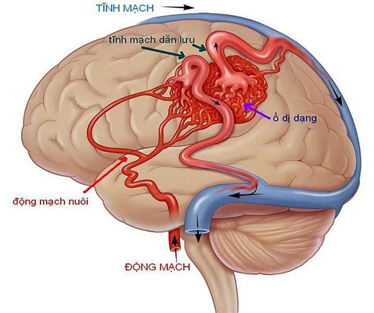 
Bệnh nhân bị dị dạng động tĩnh mạch trong não có thể được chỉ định xạ phẫu
