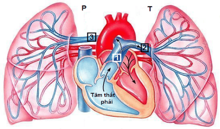 
Tắc nghẽn mạch làm tăng áp suất lên tim
