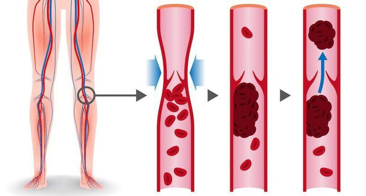 
Bẫy động mạch khoeo không được điều trị sớm sẽ hình thành cục máu đông
