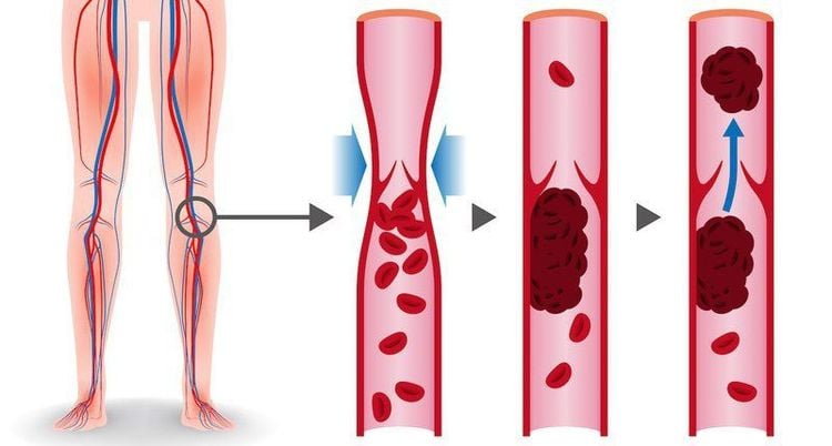 
Bẫy động mạch khoeo không được điều trị sớm sẽ hình thành cục máu đông
