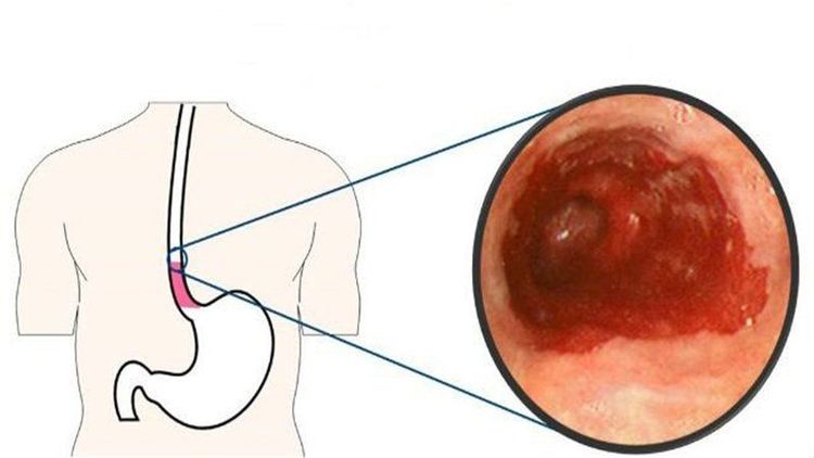 
Các lớp cơ thoái hóa dẫn đến co thắt thực quản
