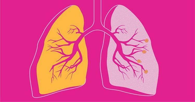 
Các chức năng của phối kém cũng làm tăng nguy cơ loãng xương của bệnh nhân COPD
