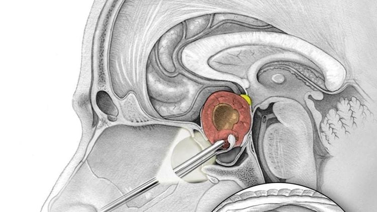 
Phẫu thuật u tuyến yên thông qua nội soi đường xương bướm
