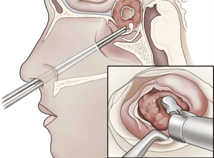 
Một số ít trường hợp bị u tuyến yên ác tính
