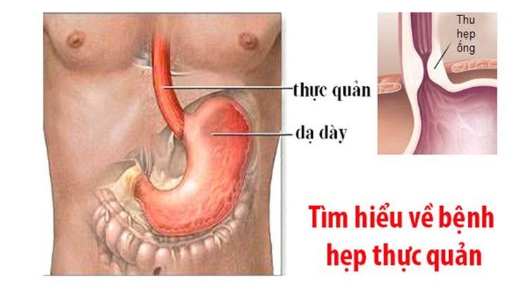 
Hẹp thực quản là biến chứng do bỏng thực quản gây ra
