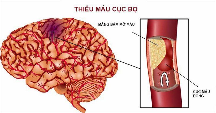 
Bệnh nhân thiếu máu não do động mạch chủ gây ra được chỉ định thực hiện
