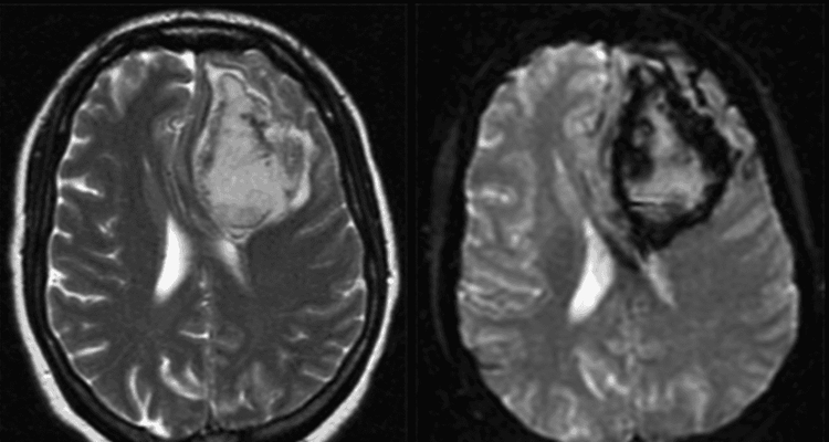 
Hình ảnh MRI xuất huyết não
