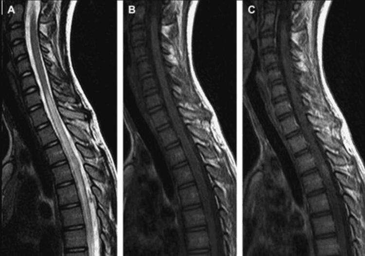 
Hình sagittal T2W thấy bất thường tín hiệu kéo dài từ T7 đến L2.
