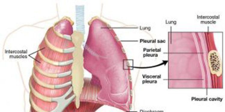 
U thành ngực xuất hiện bên ngoài xương tại vị trí lồng ngực
