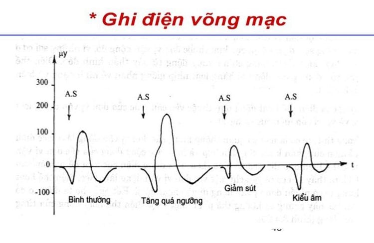 
Điện võng mạc có thể tiến hành cả cho trẻ nhỏ
