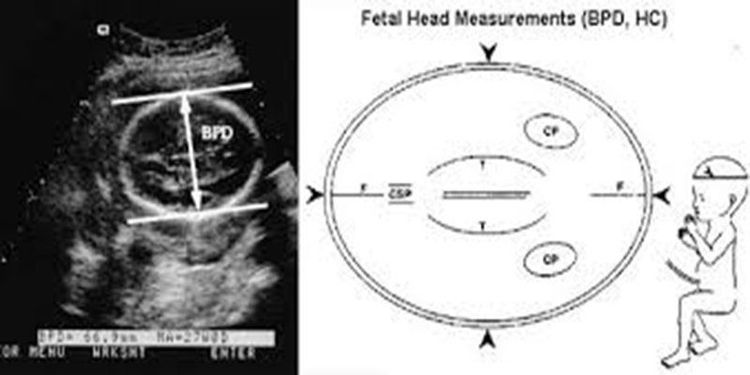 
Measuring biparietal diameter is extremely important for mother and baby
