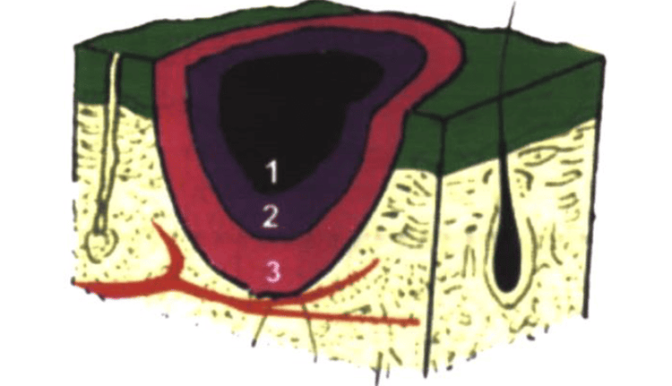 
3 vùng tổn thương của bỏng
