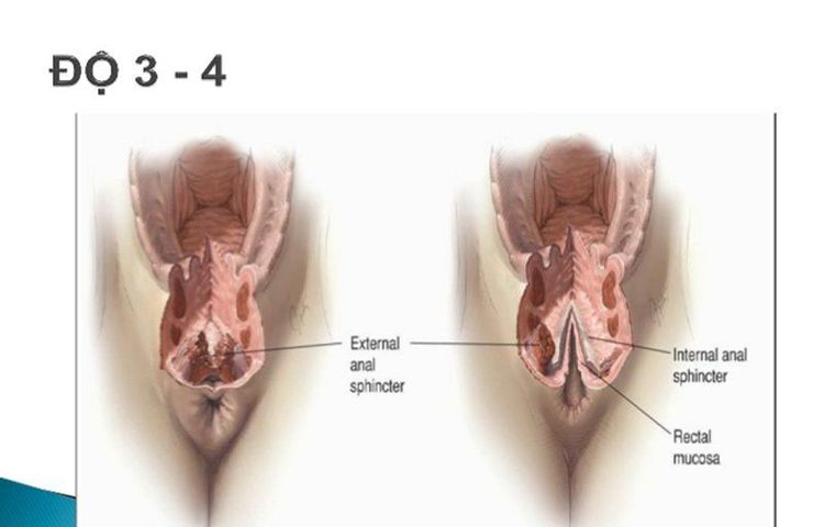 
Rách tầng sinh môn gây chảy máu kéo dài sau đẻ
