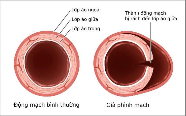 
Giả phình động mạch
