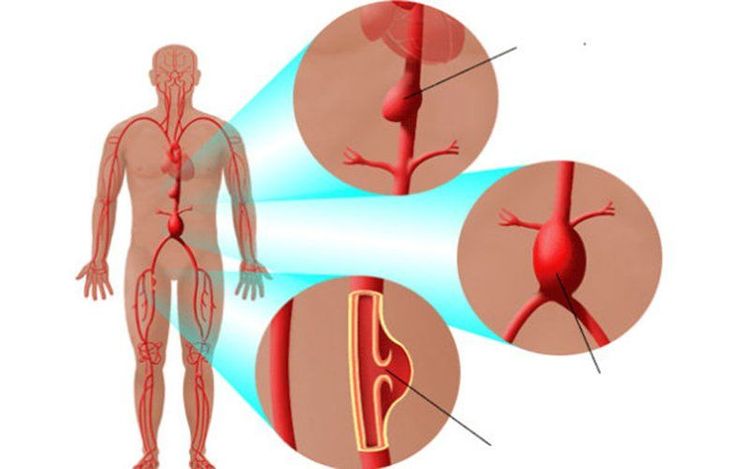 
Chụp cộng hưởng từ mạch máu thường được chỉ định khi bệnh nhân nghi phình động mạch máu
