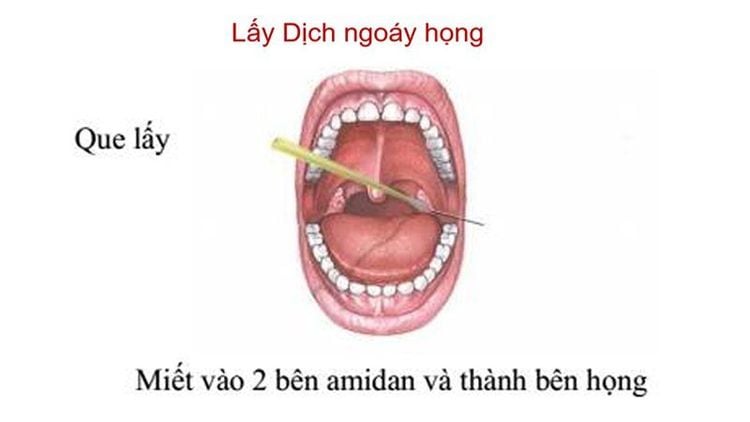 
Ngoáy họng lấy mẫu bệnh phẩm chẩn đoán viêm não mô cầu
