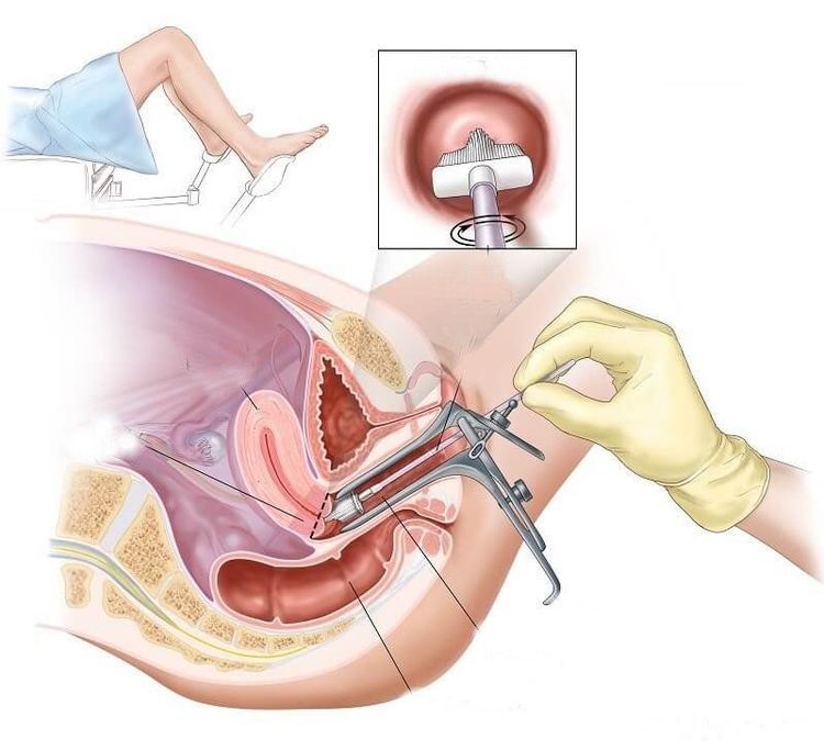 
Kỹ thuật thực hiện xét nghiệm PAP tại bệnh viện Đa khoa Quốc tế Vinmec
