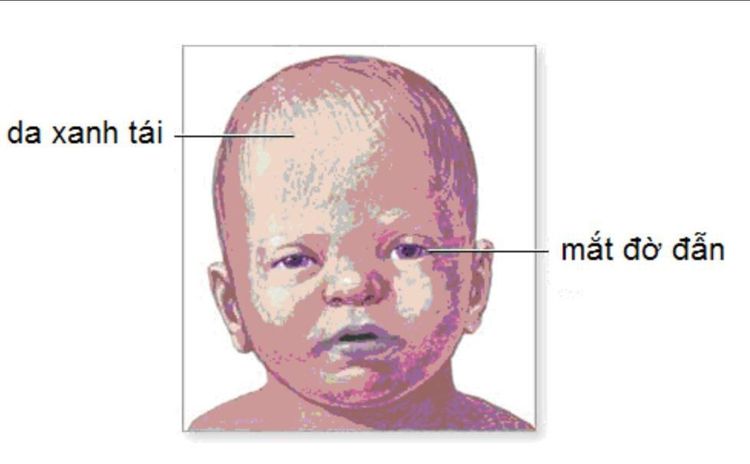 
Hình 2. Hình ảnh của một trẻ bị lắc: mắt đờ đẫn, da xanh tái, nhất là vùng trán. Ảnh từ trang web của Trung tâm quốc gia kiểm soát hội chứng trẻ bị lắc – Mỹ.
