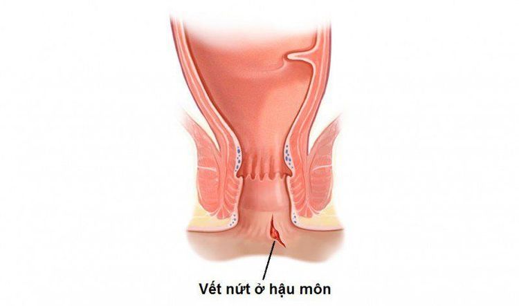 
Bệnh nứt hậu môn có các dấu hiệu rất đặc trưng, dễ nhận biết
