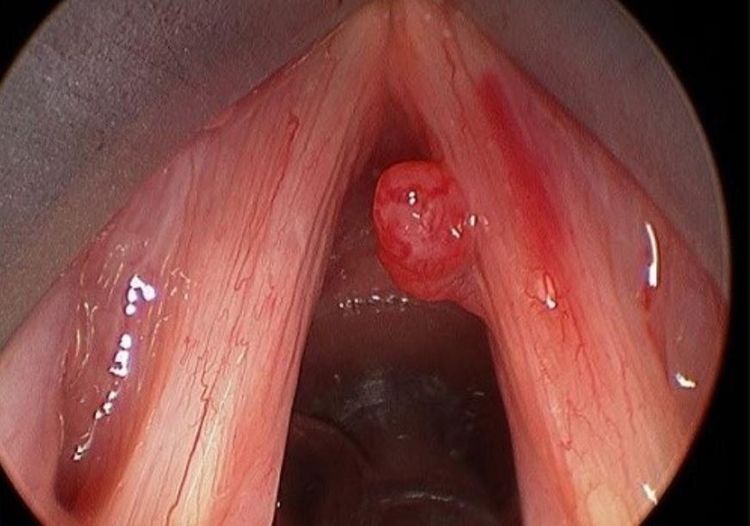 
Hình ảnh nội soi polyp thanh quản
