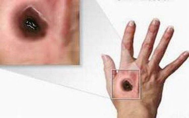 Dựa vào các triệu chứng của bệnh, bác sĩ sẽ chẩn đoán phân biệt bệnh than