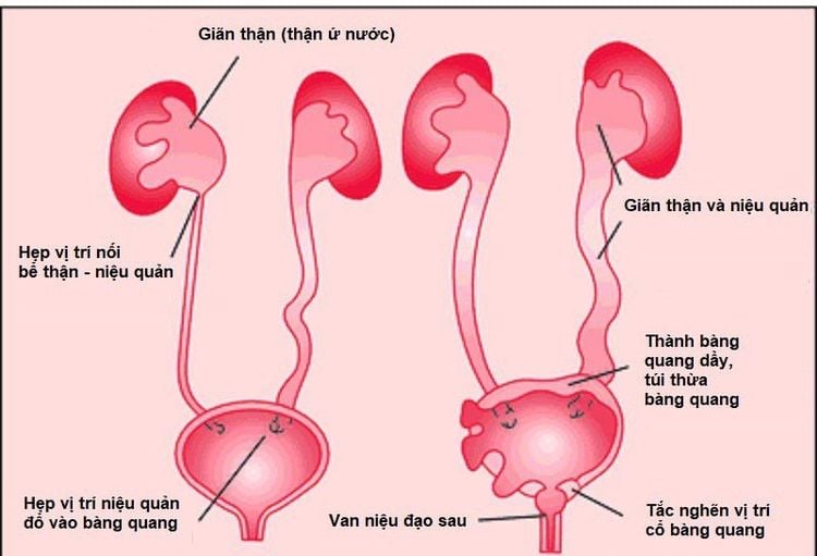 
Tắc nghẽn niệu đạo dẫn tới bệnh viêm phổi cấp tính
