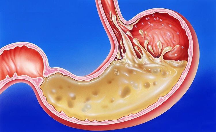 
Trào ngược axit có mối liên hệ với chứng ngưng thở khi ngủ do tắc nghẽn
