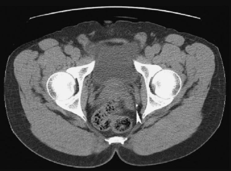 
CT-scan vùng chậu cho thấy hình ảnh sỏi niệu quản đoạn niệu quản xa bên trái
