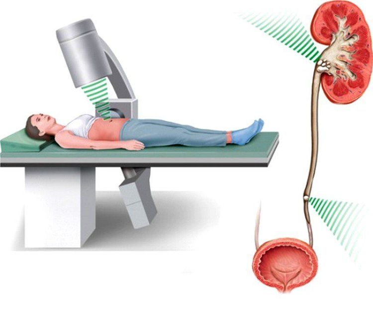 
Hình ảnh mô phỏng phương pháp tán sỏi ngoài cơ thể (Shock wave lithotripsy)
